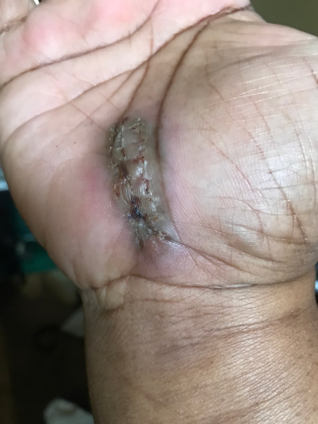 Look Ma, No&nbsp;Stitches!